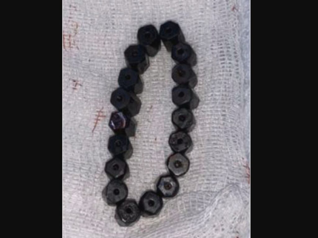 A magnetic bracelet was found in the stomach of a four-year old boy who suffers from intense pain. Four-year-old boy with intense pain is found to have magnetic bracelet in his stomach